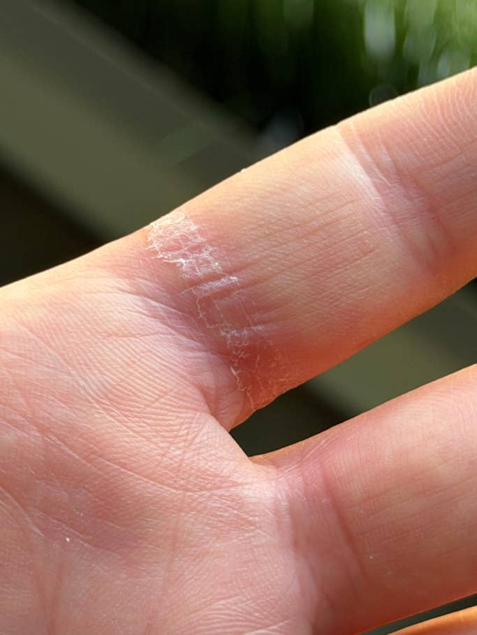 A close-up of a hand showing a skin irritation on the finger, possibly from a Samsung Galaxy Ring.
