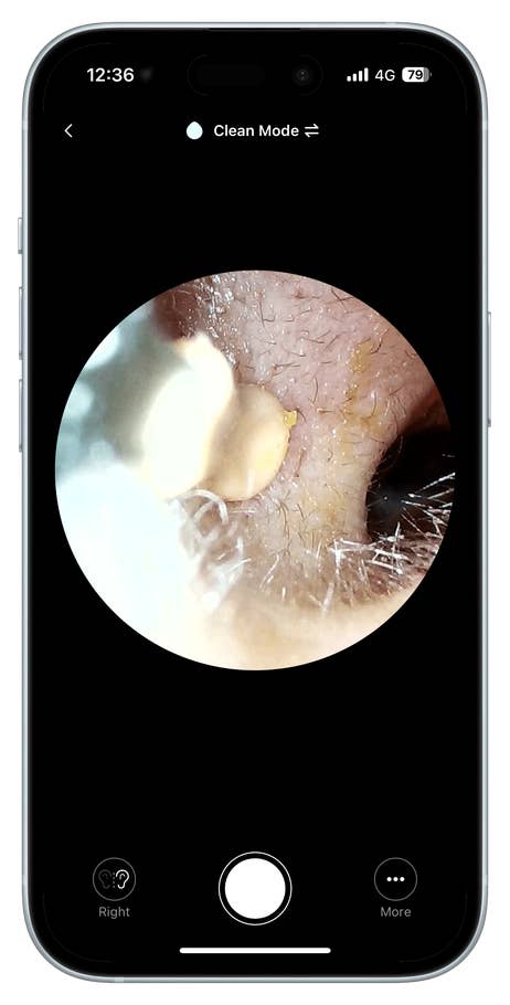 Close-up view of an ear canal with wax removal tool, displayed on a mobile screen.