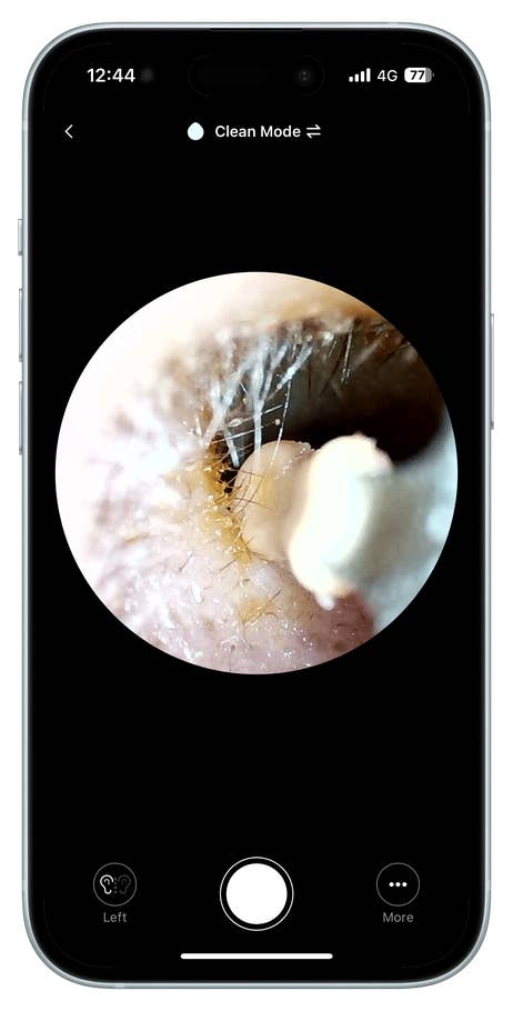 A close-up view of an ear canal displayed on a phone screen, showing wax and hair.