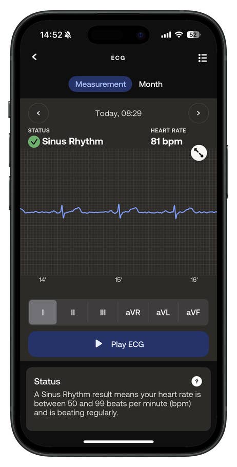 An ECG reading showing sinus rhythm with a heart rate of 81 bpm on a mobile device.